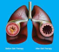 Halotherapy for Chronic Respiratory Disorders: From the Cave to the Clinical