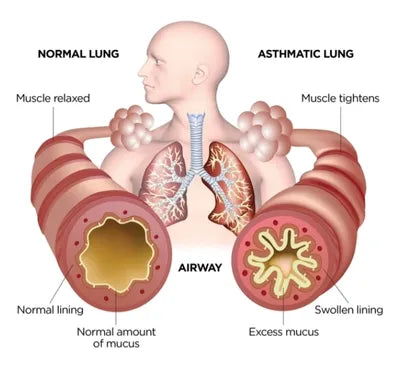 Optimization of pathogenetic therapy in patients with chronic obstructive lung disease